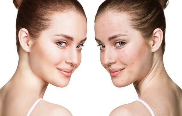 facial acne