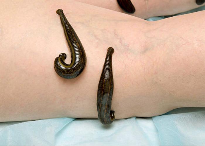 Blutegel - Einzeltherapie. 75 Min.